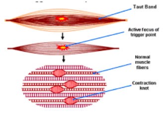 Dry Needling Diagram